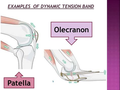 Principle of tension band wiring n its application