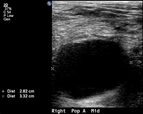 Popliteal artery aneurysm