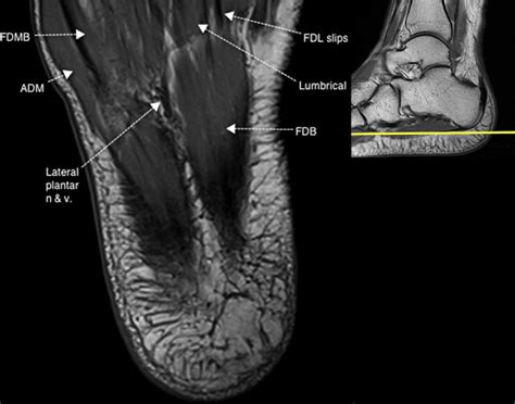 Foot Muscles Mri : The Radiology Assistant : Ankle - MRI examination ...