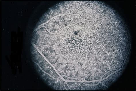 Basal Laminar Drusen / Cuticular - Retina Image Bank