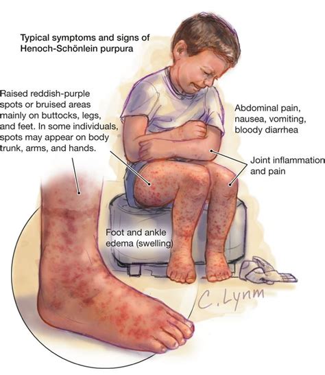 purpura - Google Search | Pediatric nursing, Pediatric nurse ...