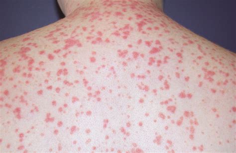 Psoriasis | Causes, Triggers, Diagnosis & Treatment