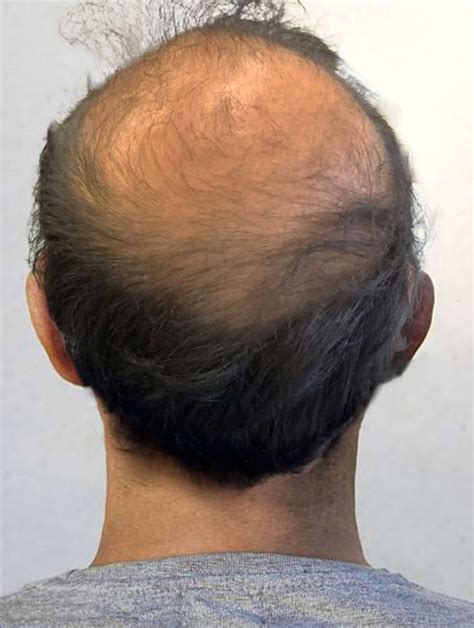 Hair Loss Treatment in London and Essex | Shumaila's