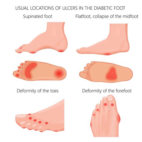 Staph Infection on the Toe or Foot [Early Signs & BEST Treatment]