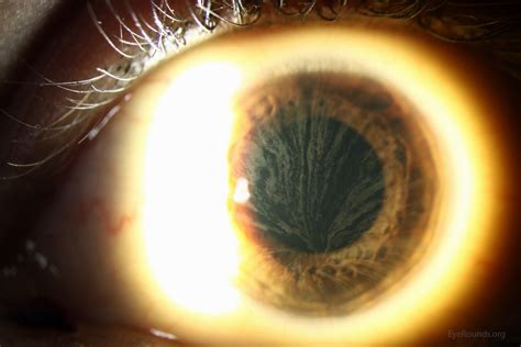 Atlas Entry - Cornea verticillata