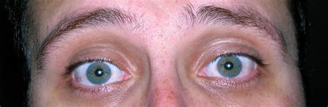 File:Blue-Green Eyes with Freckles.JPG - Wikipedia