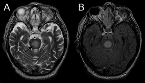 Central pontine myelinolysis | BMJ Case Reports