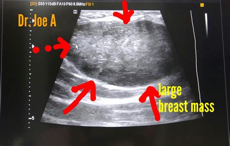 Ultrasound imaging: Giant-fibroadenoma-breast