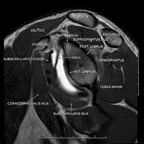 MR Arthrography Shoulder - Sumer's Radiology Blog