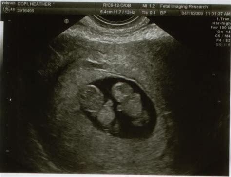 Twins Sonogram | Twins 4_11_08 2nd Ultrasound | batman | Pinterest ...