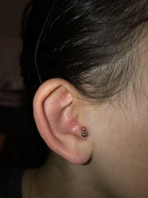 keloid tips/tragus jewelry removal tips? having a hard time with this one : r/piercing