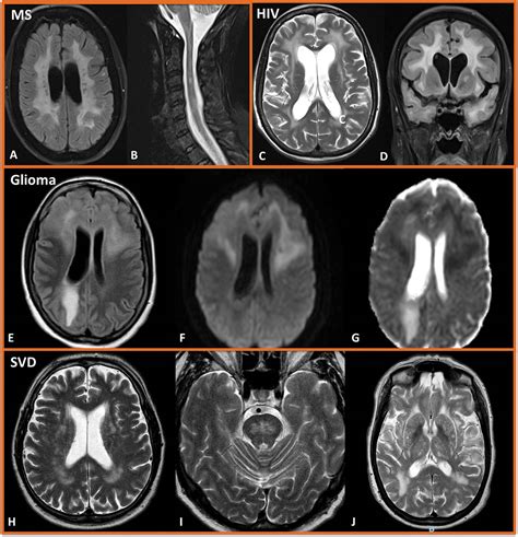 How to diagnose difficult white matter disorders | Practical Neurology