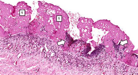 IPLab:Lab 3:Fibrinous Pericarditis - Pathology Education Instructional ...