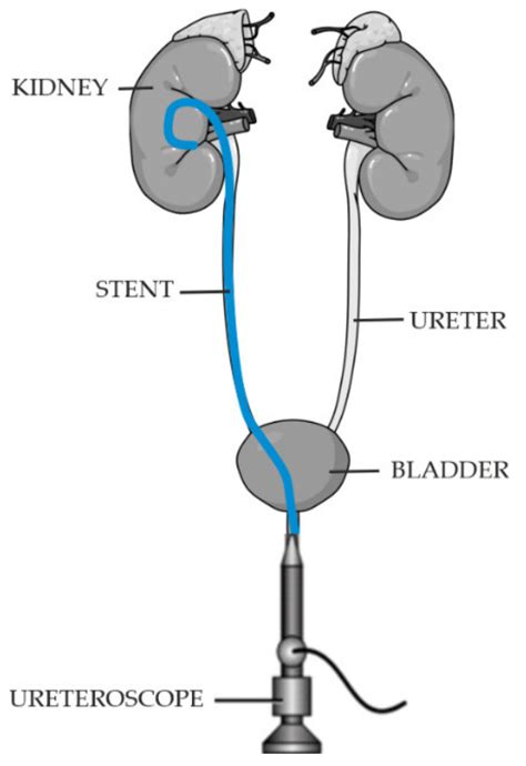 Ureteral Stent Diagram