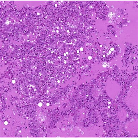 Acinic cell carcinoma with characteristic acinar-type cells with ...