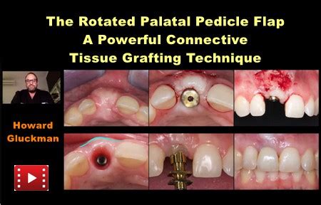 The Rotated Palatal Pedicle Flap