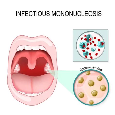 Epstein Barr Virus: Types, Symptoms, Treatment, Home Remedies | STD.GOV ...