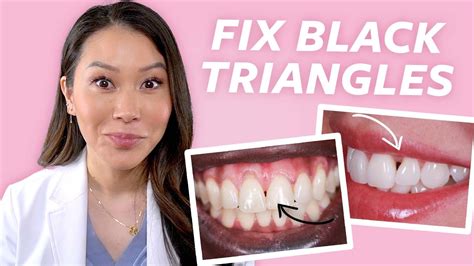 FIX Gaps in Teeth - How to Close Black Triangles - YouTube