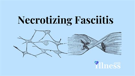 Necrotizing Fasciitis Infection