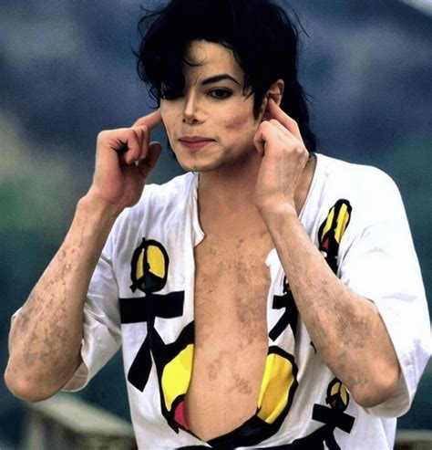 A detailed picture showing Michael Jackson's vitiligo, a skin disease he was diagnosed with in ...