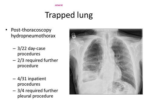 Pleural Effusion