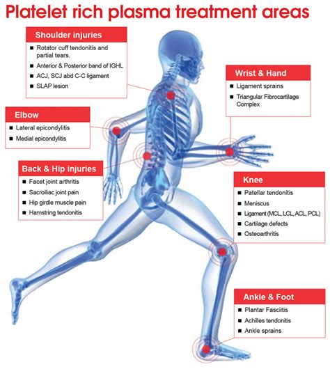 Platelet Rich Plasma (PRP Injection) Therapy Ankles Pain? Intra-articular Osteoarthritis Dubai ...