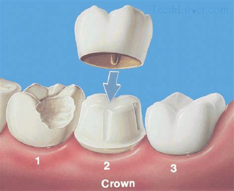 Dentistry and Medicine: Full Crowns : Restorative Dentistry Lecture Note