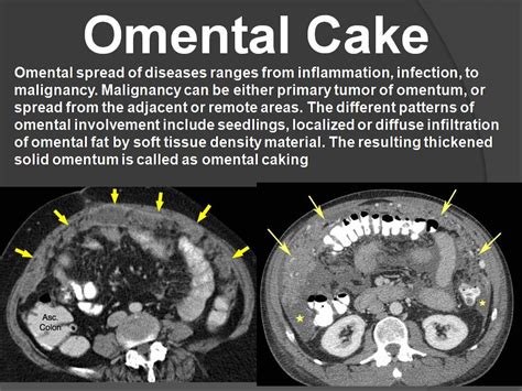 OMENTAL CAKE - Radiology Classroom