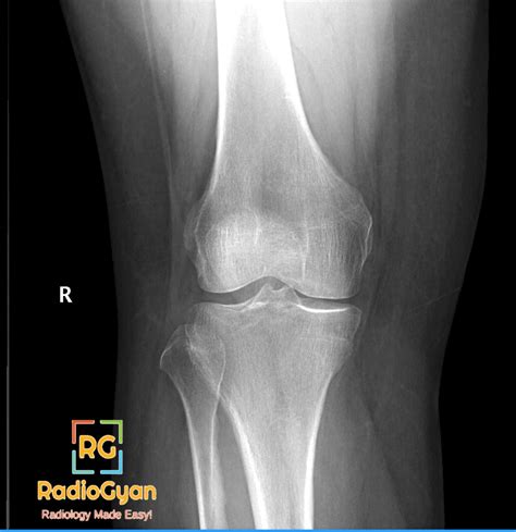 Tibial Plateau Fracture || Radiology Cases || RadioGyan.com - RadioGyan