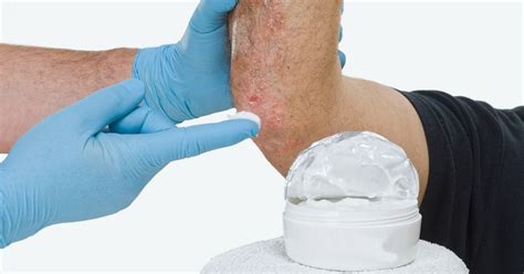 Psoriasis: Early Treatment Benefits