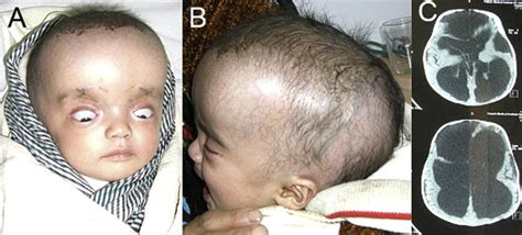 Resolution of the Sunset Sign - Pediatric Neurology