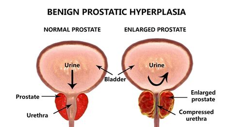 Benign Prostatic Hyperplasia Melbourne | North Eastern Urology