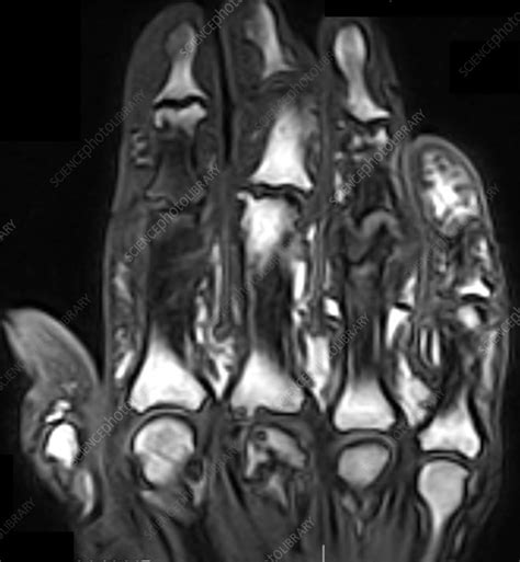 Psoriatic arthritis, stir MRI scan - Stock Image - C058/4522 - Science Photo Library