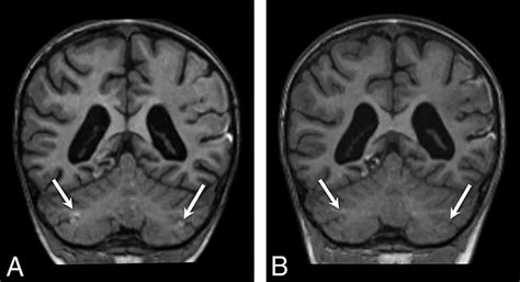 HIE Brain Imaging | Birth Injury Law Firm