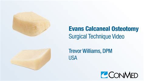 Dr. Williams - Evans Calcaneal Osteotomy - Wedges and Revision Cores ...