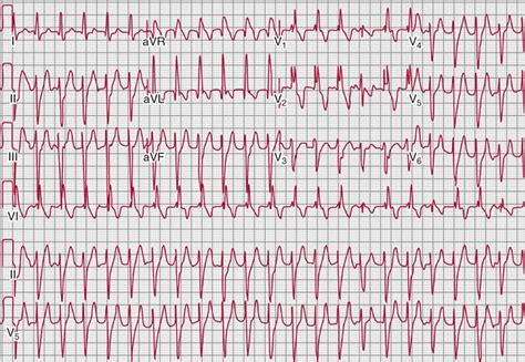 Ventricular tachycardia causes, symptoms, diagnosis, prognosis & treatment