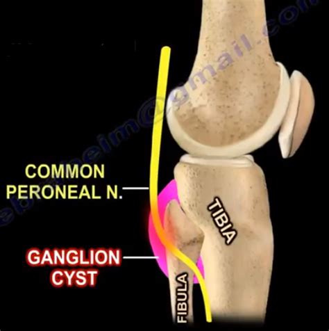 Ganglion Cyst Around the Knee. Ganglion cyst of the cruciates can… | by Nabil Ebraheim | Medium