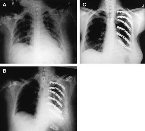 The Management of Flail Chest - Thoracic Surgery Clinics