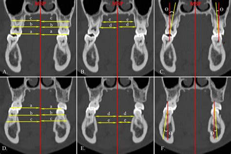 Dentoalveolar measurements of first molars on coronal view. A, D a, the ...