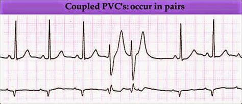 Premature Ventricular Contraction / Ventrikular Ekstrasistol | INA - ECG