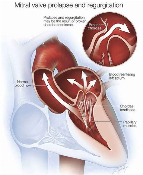 Mitral regurgitation causes - MEDizzy