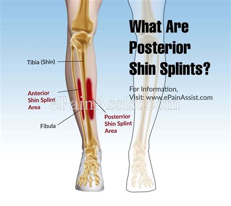 What Are Posterior Shin Splints?