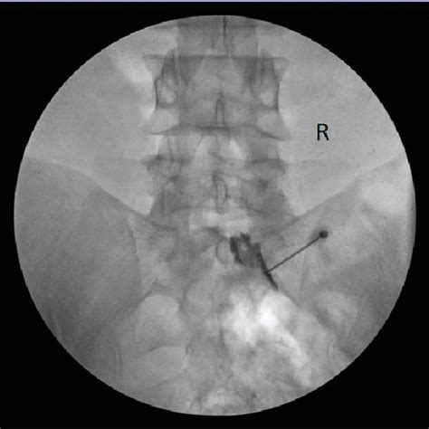 Figure 3 from Recovery of H-Reflex with Transforaminal Epidural Steroid Injection in S1 ...