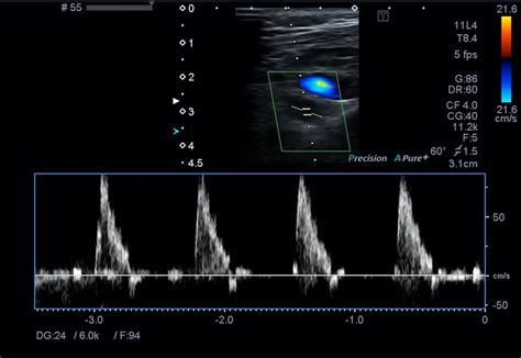 Normal color Doppler ultrasound image showing the subclavian artery... | Download Scientific Diagram