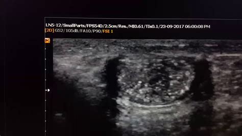 Testicular Microlithiasis Sonography - YouTube