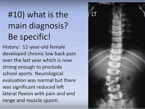 Congenital Scoliosis — OrthopaedicPrinciples.com