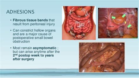 Post operative adhesions and management