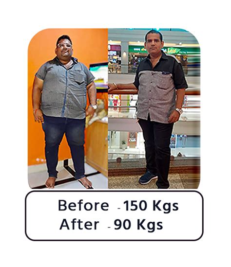 Bariatric Surgery - Before & After (Success Story) - Dr. Manish Motwani