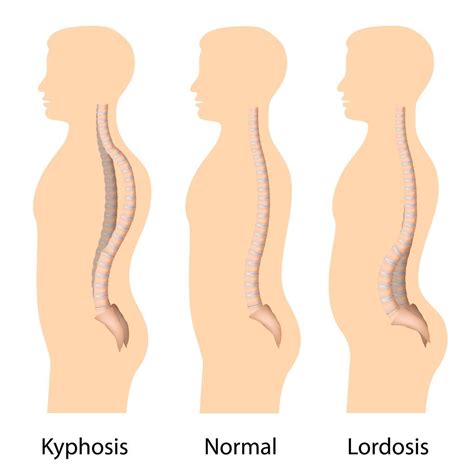 Pin on Lumbar Lordosis