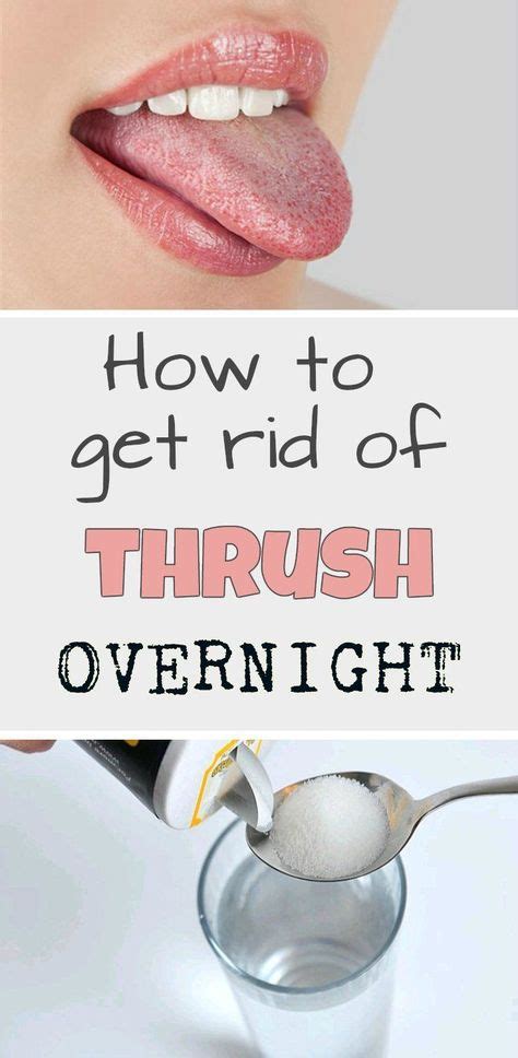 Learn how to get rid of thrush overnight. #BeautyMakeup #yeastinfectiontreatmentforkids | Oral ...